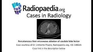 Percutaneous liver microwave ablation of caudate lobe lesion Radiopaediaorg Cases in Radiology [upl. by Beverley997]