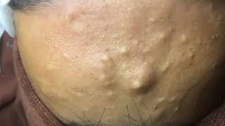 How to Remove Blackheads And Whiteheads On Face Easy ✦ Acne Treatment ✦ [upl. by Slosberg]