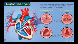 IM Cardiology 12 Valvular Heart Diseases Aortic Stenosis AS [upl. by Wylie504]