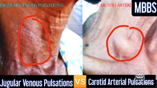 Jugular Venous Pulsations 🆚 Carotid Arterial Pulsations medicine mbbs cvs usmle neetpg [upl. by Martz]