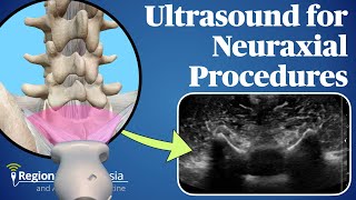 Ultrasound for Neuraxial Procedures [upl. by Shir1]