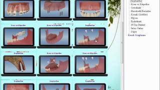 NovaSoft Dental Patient Education 3D Animation Software for Dentist [upl. by Ertnod]