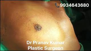 GYNECOMASTIA Grade 2 Immediate Postop ontable resultsDr Pranav Kumar Patna [upl. by Nyllek]