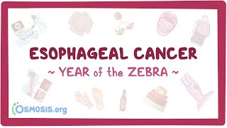 Esophageal Cancer Year of the Zebra [upl. by Earas785]