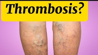 What is thrombosis and is it dangerous [upl. by Alinna559]