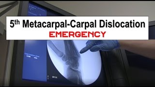 Fifth Metacarpal Dislocation and Reduction Emergency [upl. by Hilarius346]