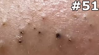 quot🔴 Satisfying Pimple Popping Extravaganza Watch the Most Satisfying Pops Everquot 51 [upl. by Strauss786]