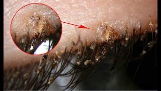 Pubic lice Symptoms – Causes Treatment Signs and Symptoms of Pubic lice and Pubic Crab [upl. by Nalim721]