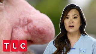 Dr Lee Reconstructs A Nose With Rhinophyma  Dr Pimple Popper Pop Up  UNCENSORED [upl. by Rice919]