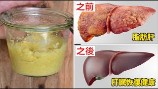 專家：這食物竟逆轉脂肪肝、預防肝癌！遠離肝臟病變，一輩子遠離肝癌！ [upl. by Alihet]