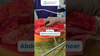 HIPEC therapy for Pseudomyxoma peritoneum a Rare Abdominal Cancer abdominalcavity hipec [upl. by Eseela251]