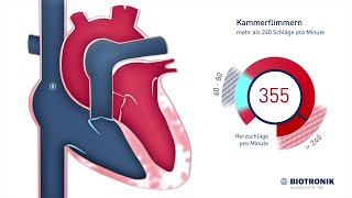 Kammerflimmern amp plötzlicher Herztod Animation [upl. by Lauraine]