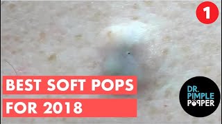 The BEST OF Softpops 2015 for 2018 Part 1 Dr Pimple Popper [upl. by Ahders]