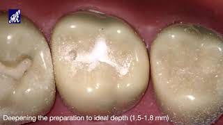 Class I Cavity Preparation Tooth 17 [upl. by Assina]