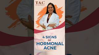 4 Signs of hormonal Acne  How I Got Rid of Hormonal Acne  Hormonal Acne Treatment [upl. by Benjamen]