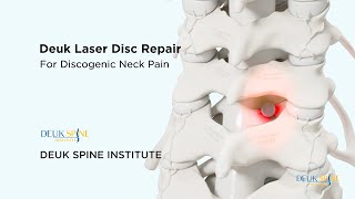 Cervical Deuk Laser Disc Repair DLDR for Discogenic Neck Pain  3D Animation [upl. by Uahsoj]