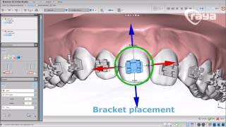 Cementado indirecto de Brackets  3 Formas con Maestro3D Dental Studio  Ortho Studio [upl. by Anitsuga105]