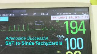 SVT or Supraventricular Tachycardia [upl. by Idnor]