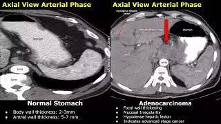 CT Scan Normal Stomach Vs Gastric Adenocarcinoma Images  Early amp Advanced Stage Cancer Cases [upl. by Deanna]