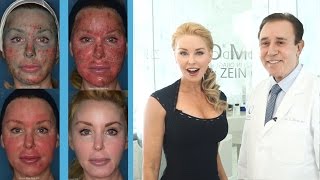 Dr Obagi Blue Peel  Amazing Before and After Results  AntiAging Skincare Over 40 [upl. by Llenwahs]