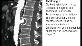 Kolikartige Flankenschmerzen bedingt durch symptomatisches Aortenulkus [upl. by Imogene]