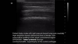 CASE 956 Tietze syndrome [upl. by Aikram]