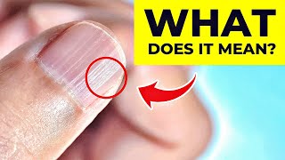 What Do Vertical Ridges On Your Nails Mean The REAL Cause [upl. by Philoo406]