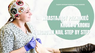 Ingrown nails step by step  Wrastający paznokieć krok po kroku [upl. by Kristyn973]