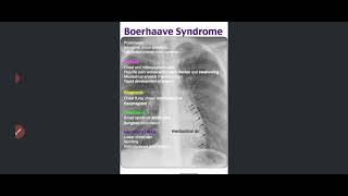 Internal Medicine  Pulmonology Pleural Effusion [upl. by Aissatsan367]