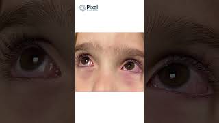 Conjunctivitis EYE in children  Dr Abdul Rasheed  conjunctivitis conjunctivitistreatment [upl. by Albin305]