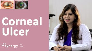 Corneal Ulcer  What causes it What are the symptoms What is the treatment [upl. by Ansaev712]