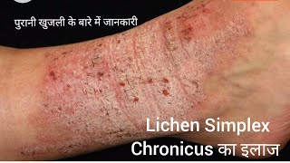 Lichen Simplex Chronicus  Lichen Planus lichenplanus pruritus itchingtreatment itchingproblem [upl. by Euqinay2]