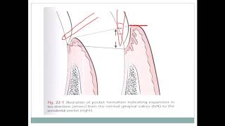 Fall 2020  Periodontology 1  Lec 7  Periodontitis [upl. by Oruasi]