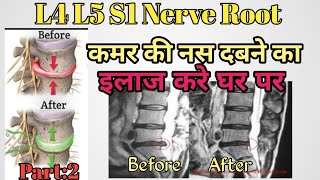 L4 L5 S1 nerve root compression exercises  buldging Disc exercises  Herniated Exercise  in hindi [upl. by Eveneg]