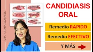 😬3 Remedios naturales para CANDIDIASIS oralesCándida AlbicanscausastratamientoEpisodio 61 [upl. by Gurango357]