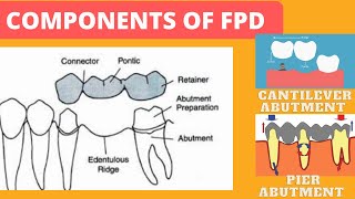 COMPONENTS OF FPD  CANTILEVER ABUTMENT  PIER ABUTMENT component prosthodontics abutment [upl. by Nivel]