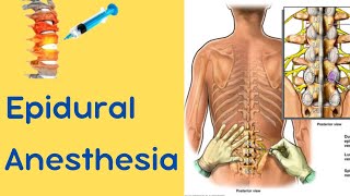 Epidural Anesthesia [upl. by Lekram]