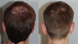 Haartransplantation Haarbepflanzung mit FUE  Tonsur  2267 Grafts [upl. by Burtie]