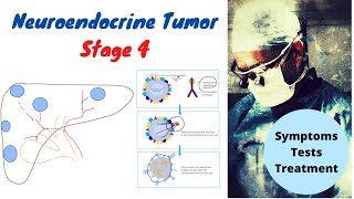 Neuroendocrine Tumor Stage 4 Symptoms Tests Treatment [upl. by Eicrad907]