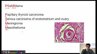 Pathologies Associated with psammoma bodies mnemonic [upl. by Alyakim]