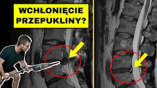 Przepuklina  czy może się cofnąć rwa kulszowa dyskopatia kręgosłup lędźwiowy [upl. by Drawyeh849]
