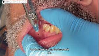 Incisive dental injection [upl. by Yetsirhc]