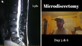 Microdiscectomy Day 5 amp 6 Post Surgery L5S1 [upl. by Corell]