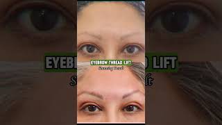 Eyebrow Transformation Procedure [upl. by Egwan486]