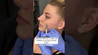 Demonstration of where cheek filler would be placed cheekfiller cheekfillers contouredcheeks [upl. by Fatma]