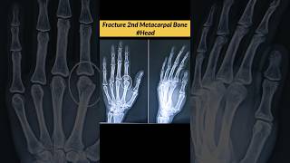 FRACTURE 2nd Metacarpal Bone oF Hand radiographerusn radiography radiographer xray [upl. by Baird]