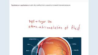 Papilledema Explained by Sultan Binobaid [upl. by Ahsart169]