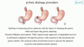 pyloric drainage procedure [upl. by Attennaj]