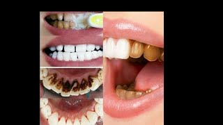 DIENTES SUPER BLANCOS EN 2MINUTOS 💋remedios caseros efectivos [upl. by Eelahc]