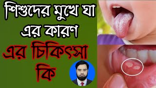 শিশুদের মুখের ঘা এর কারণ ও হোমিওপ্যাথিক চিকিৎসাbanglahealthtipsstomatitis [upl. by Anairad]